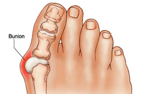 ภาวะนิ้วโป้งเท้าเกออก (HALLUX VALGUS หรือ BUNIONS)